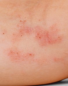 Right forearm in week 1: several red, scaly eczema patches.