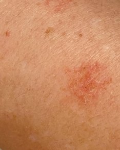 Right forearm in week 2: two smaller, fainter patches.
